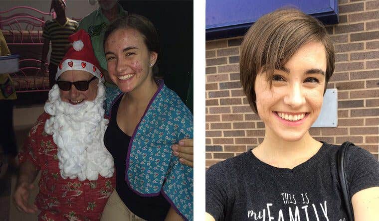 Kiernan Holstein Two photos of Kiernan Holstein, in the left photo Keirnan has acne while on the right photo her skin is clear
